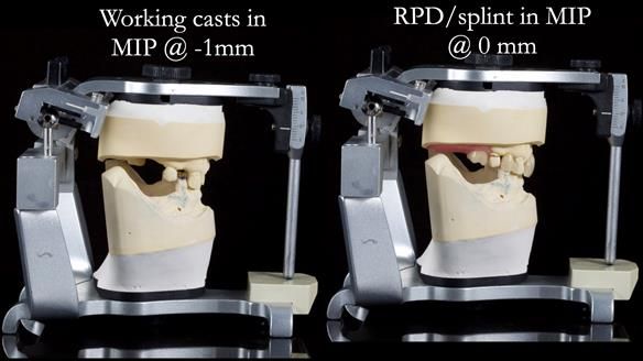 Managing Edgar “THE SCEPTIC” with an RPD/Splint FULL CASE