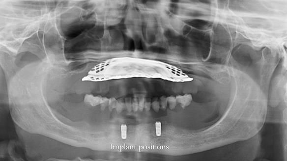 Newsletter 70 Complete Denture Treatment for Kate: A Case Study on Natural-Looking Dentures and Implant-Supported Overdentures