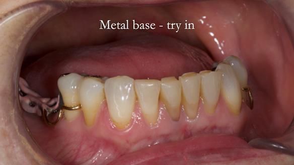 Solving Linda’s Failed “All on 4” implant bridges - full protocol Newsletter 42