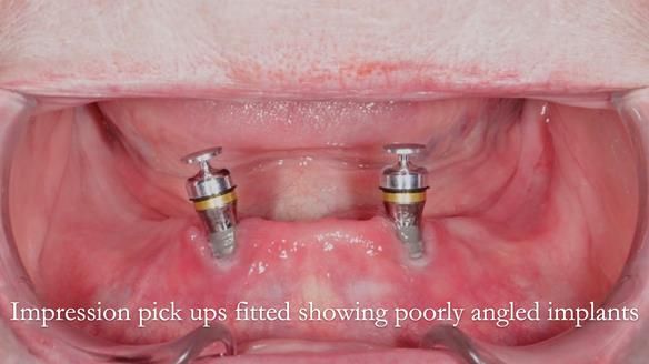 Newsletter 65 Marisa Provision of Complete Dentures on badly placed implants