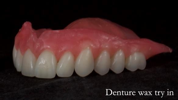 Newsletter 68 Restoring Jan’s Smile: Complete Dentures Inspired by Her Daughter’s Teeth - Post Mouth Surgery