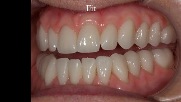 Newsletter 68 Restoring Jan’s Smile: Complete Dentures Inspired by Her Daughter’s Teeth - Post Mouth Surgery