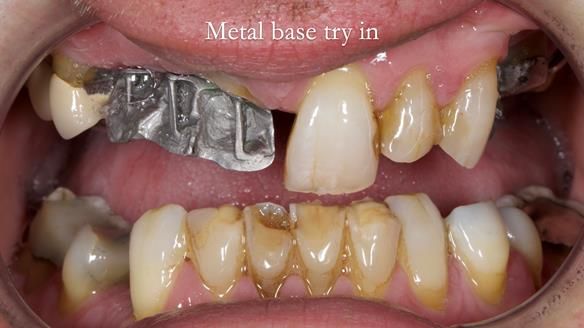 Read Newsletter 67 - Brian's COMBAT DENTURE Case Study