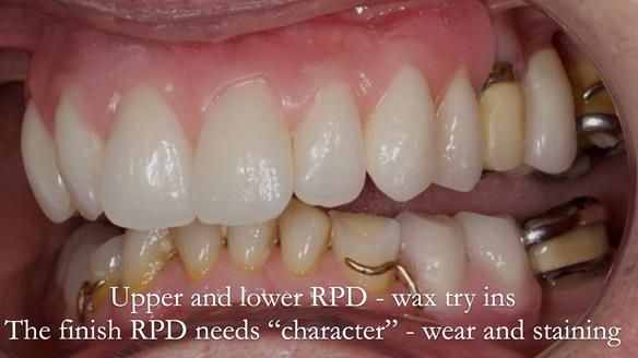 Eileen's transformation with upper and lower RPDs of Scandinavian hygienic design FULL PROTOCOL