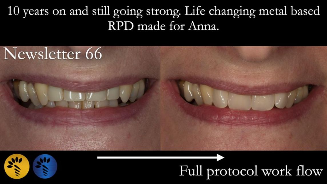 Newsletter 66 Long term case study. Life changing metal based RPD made for Anna