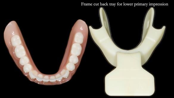 Newsletter 70 Complete Denture Treatment for Kate: A Case Study on Natural-Looking Dentures and Implant-Supported Overdentures