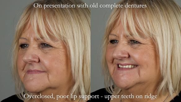 Newsletter 68 Restoring Jan’s Smile: Complete Dentures Inspired by Her Daughter’s Teeth - Post Mouth Surgery