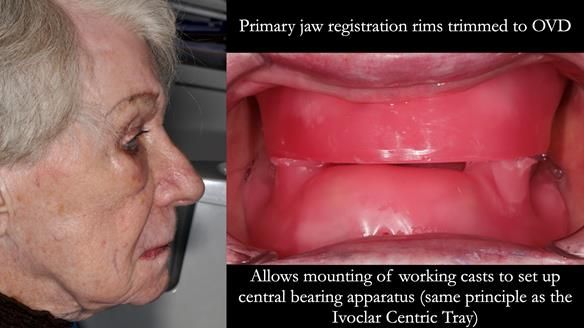 Newsletter 65 Marisa Provision of Complete Dentures on badly placed implants