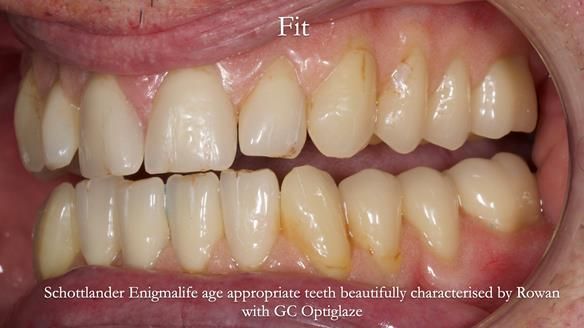 Newsletter 74: Ken’s Case Study Complete Dentures - Life Like and Age Appropriate