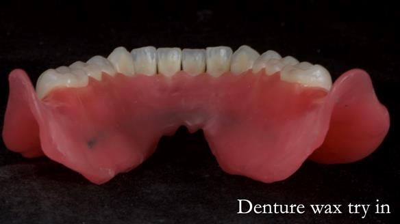 Newsletter 70 Complete Denture Treatment for Kate: A Case Study on Natural-Looking Dentures and Implant-Supported Overdentures