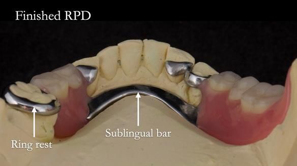 Eileen's transformation with upper and lower RPDs of Scandinavian hygienic design FULL PROTOCOL