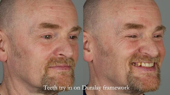 How Keith’s combat denture transformed his life – Newsletter 73