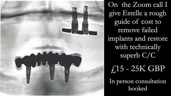 Newsletter 49 Managing Estelle’s failing implants with dentures FULL PROTOCOL