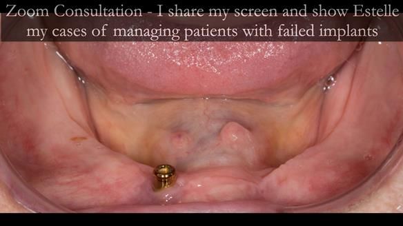 Newsletter 49 Managing Estelle’s failing implants with dentures FULL PROTOCOL