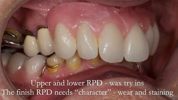 Eileen's transformation with upper and lower RPDs of Scandinavian hygienic design FULL PROTOCOL