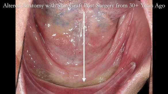 Newsletter 68 Restoring Jan’s Smile: Complete Dentures Inspired by Her Daughter’s Teeth - Post Mouth Surgery