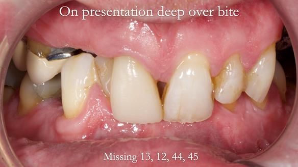 Read Newsletter 67 - Brian's COMBAT DENTURE Case Study