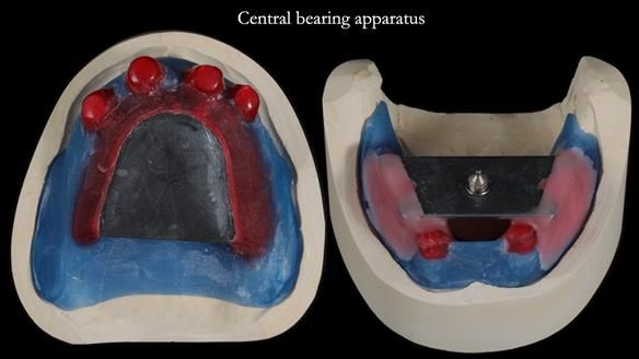 Newsletter 65 Marisa Provision of Complete Dentures on badly placed implants