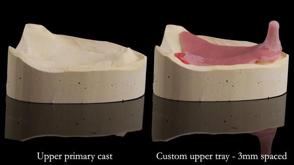 Replacing Madeline’s Complete denture FULL PROTOCOL