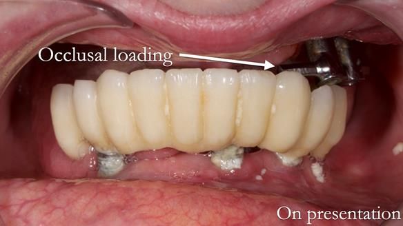 Newsletter 49 Managing Estelle’s failing implants with dentures FULL PROTOCOL