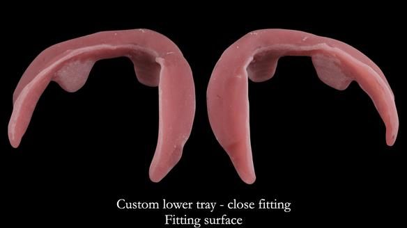 Replacing Madeline’s Complete denture FULL PROTOCOL