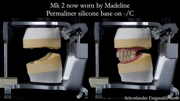 Replacing Madeline’s Complete denture FULL PROTOCOL