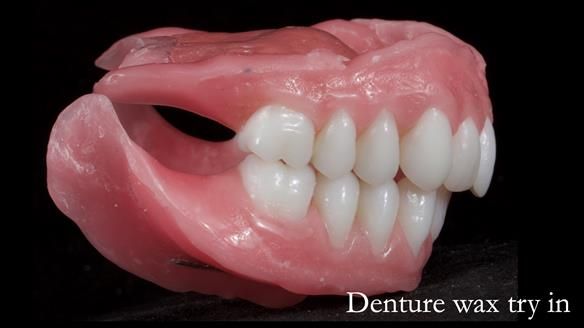 Newsletter 65 Marisa Provision of Complete Dentures on badly placed implants