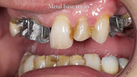 Read Newsletter 67 - Brian's COMBAT DENTURE Case Study