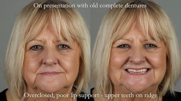 Newsletter 68 Restoring Jan’s Smile: Complete Dentures Inspired by Her Daughter’s Teeth - Post Mouth Surgery