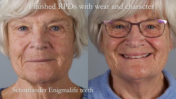 Eileen's transformation with upper and lower RPDs of Scandinavian hygienic design FULL PROTOCOL