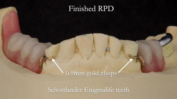 Eileen's transformation with upper and lower RPDs of Scandinavian hygienic design FULL PROTOCOL