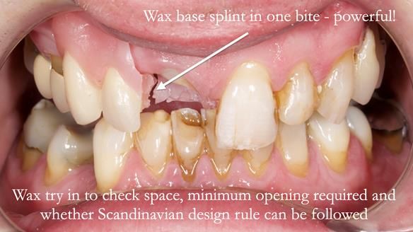 Read Newsletter 67 - Brian's COMBAT DENTURE Case Study