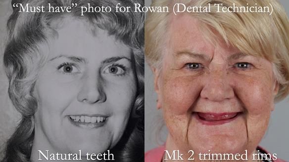 Replacing Madeline’s Complete denture FULL PROTOCOL