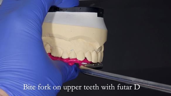 Newsletter 44 - extreme removable prosthodontics – engineering a super-strong and ultra-thin over denture