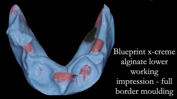 Newsletter 44 - extreme removable prosthodontics – engineering a super-strong and ultra-thin over denture