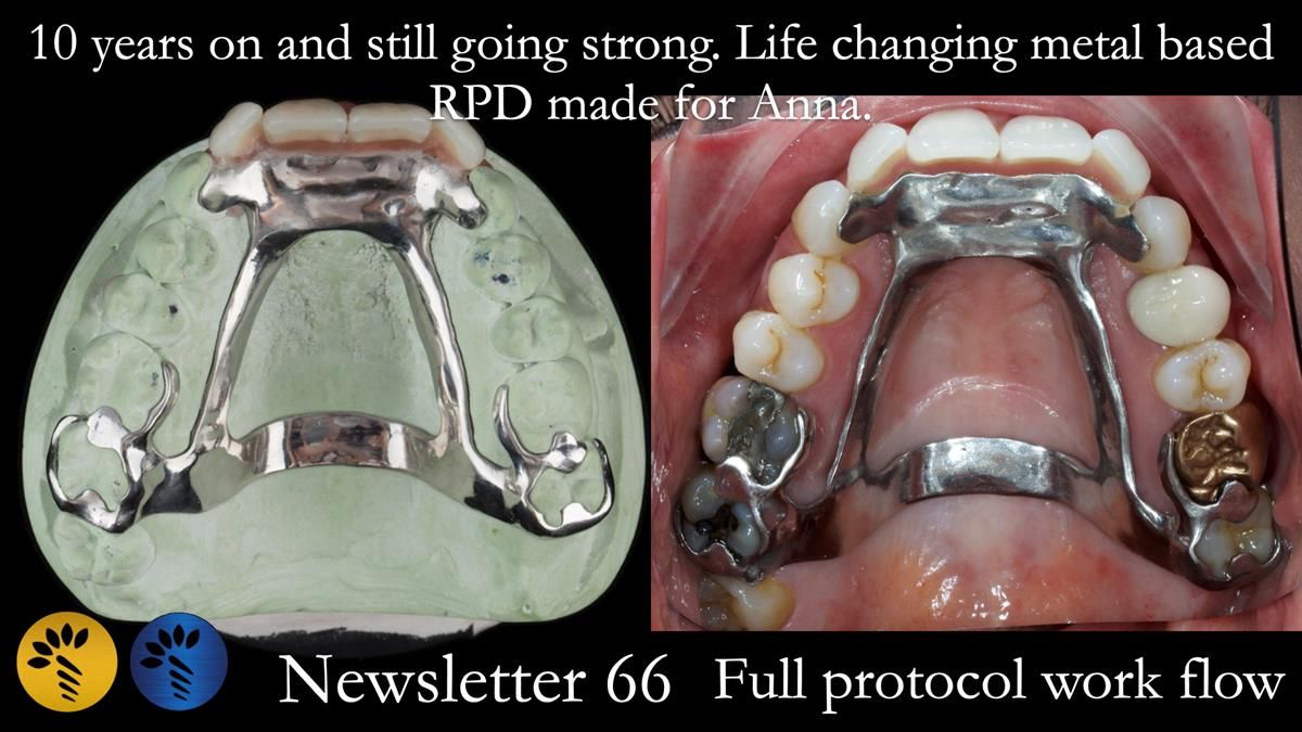 Newsletter 66 Long term case study. Life changing metal based RPD made for Anna