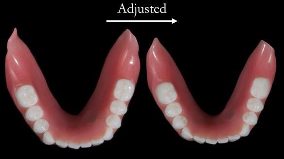 Newsletter 65 Marisa Provision of Complete Dentures on badly placed implants