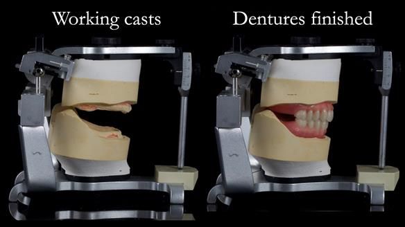 Newsletter 70 Complete Denture Treatment for Kate: A Case Study on Natural-Looking Dentures and Implant-Supported Overdentures