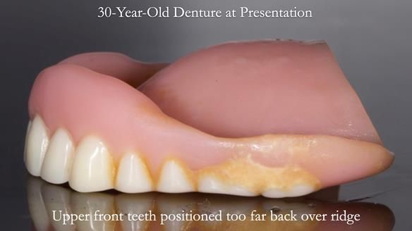 Newsletter 68 Restoring Jan’s Smile: Complete Dentures Inspired by Her Daughter’s Teeth - Post Mouth Surgery