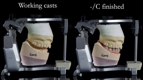 Newsletter 44 - extreme removable prosthodontics – engineering a super-strong and ultra-thin over denture