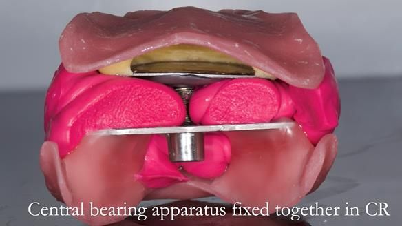 Replacing Madeline’s Complete denture FULL PROTOCOL