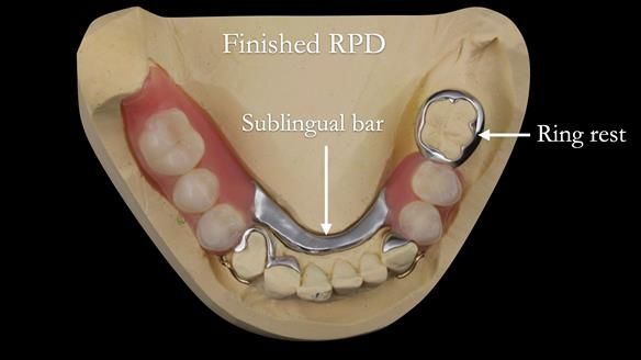 Eileen's transformation with upper and lower RPDs of Scandinavian hygienic design FULL PROTOCOL