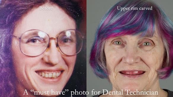 Newsletter 70 Complete Denture Treatment for Kate: A Case Study on Natural-Looking Dentures and Implant-Supported Overdentures