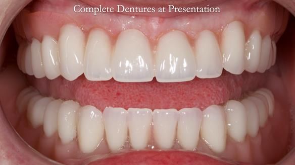 Newsletter 70 Complete Denture Treatment for Kate: A Case Study on Natural-Looking Dentures and Implant-Supported Overdentures