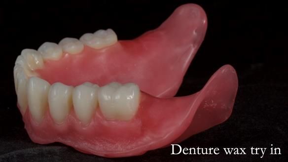 Newsletter 70 Complete Denture Treatment for Kate: A Case Study on Natural-Looking Dentures and Implant-Supported Overdentures