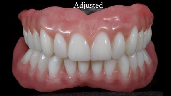 Newsletter 65 Marisa Provision of Complete Dentures on badly placed implants