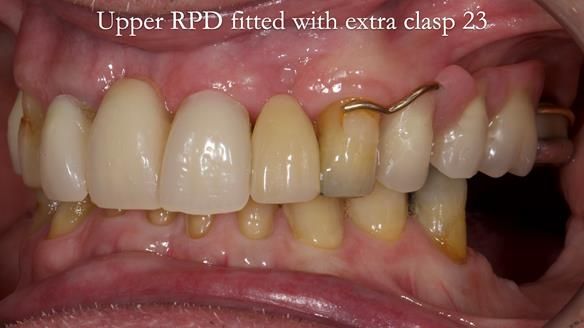 Managing Edgar “THE SCEPTIC” with an RPD/Splint FULL CASE