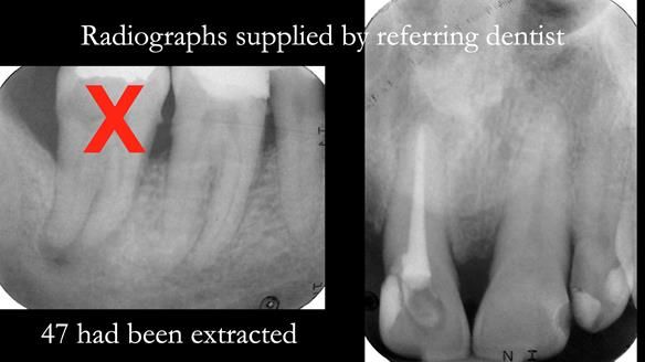 Read Newsletter 67 - Brian's COMBAT DENTURE Case Study