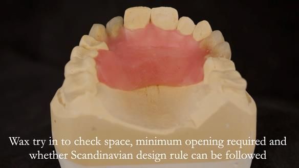 Read Newsletter 67 - Brian's COMBAT DENTURE Case Study