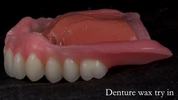 Newsletter 70 Complete Denture Treatment for Kate: A Case Study on Natural-Looking Dentures and Implant-Supported Overdentures